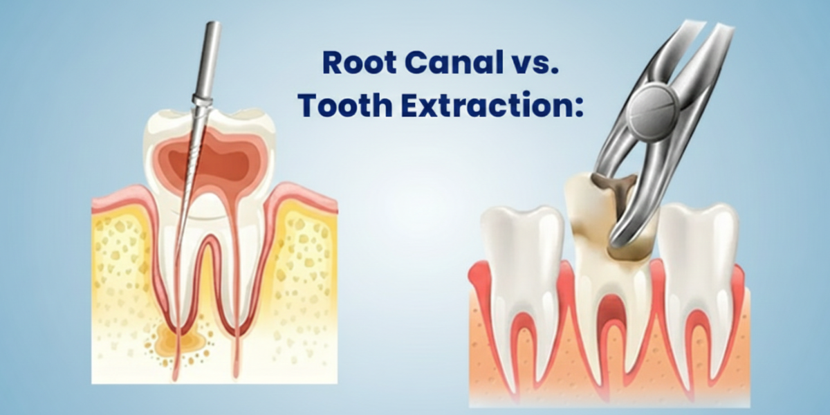 How to Maintain Oral Hygiene and Understanding Root Canal vs. Tooth Extraction